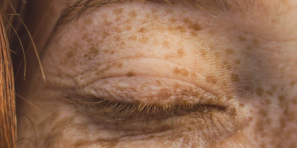 ¿SABES CÓMO TRATAR LAS MANCHAS SOLARES?