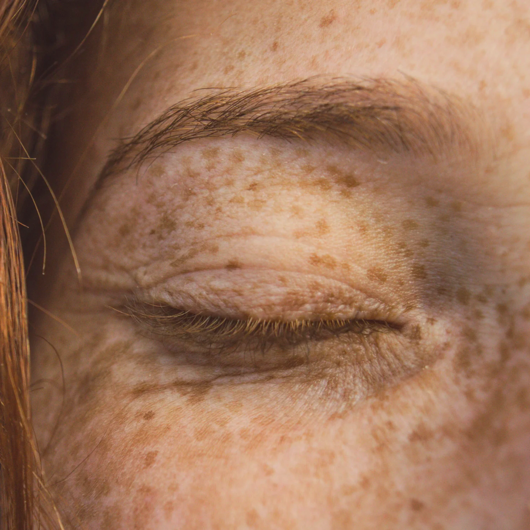 ¿SABES CÓMO TRATAR LAS MANCHAS SOLARES?